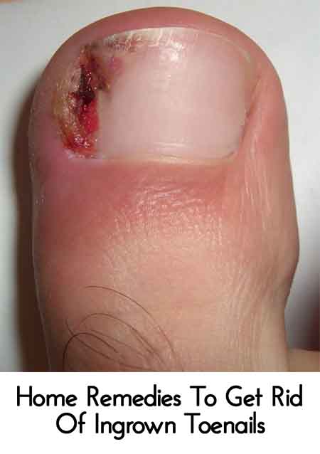 Home Remedies To Get Rid Of Ingrown Toenails - Lil Moo Creations
