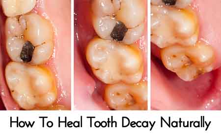 reversing tooth decay